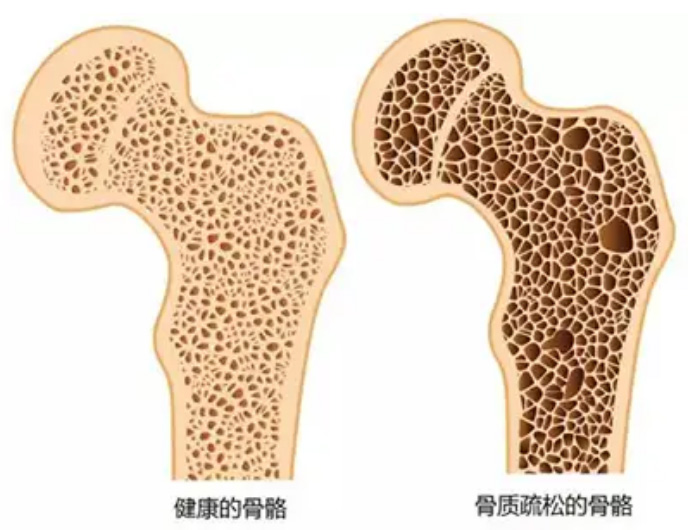  PQQ 可刺激成骨細胞形成 從而預防骨質疏松症